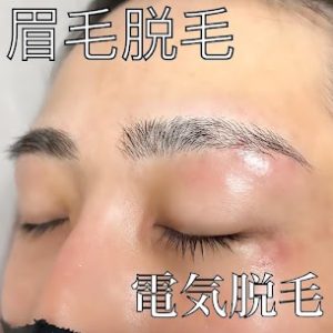 眉下脱毛