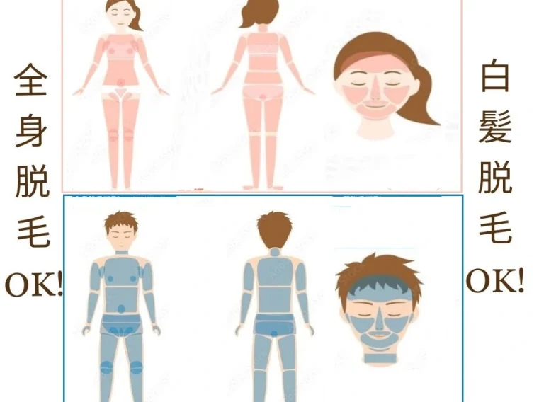 全身の電気脱毛.webp